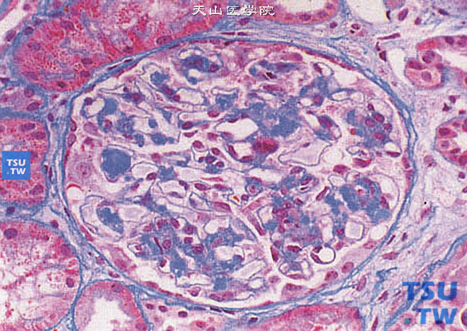 肾淀粉样变性（Masson染色），肾小球中心系膜区中心毛细血管和基底膜上均有被染成蓝色的淀粉样物质沉着