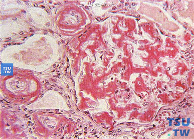 肾淀粉样变性（Congo red染色），示肾小球和小动脉壁的淀粉样物质