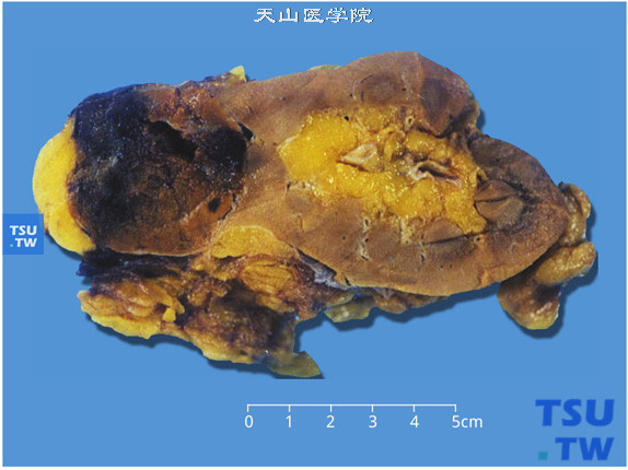 成人肾嗜酸细胞腺瘤（Oncocytoma）