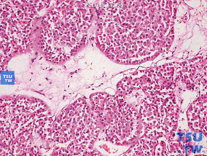 肾嗜酸细胞瘤（oncocytoma），肿瘤细胞呈圆形或多角形，胞质内有较多嗜酸性颗粒