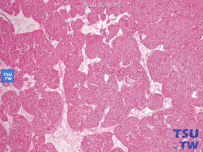 肾嗜酸细胞瘤（oncocytoma），细胞排列成实性巢索状，间质细胞少