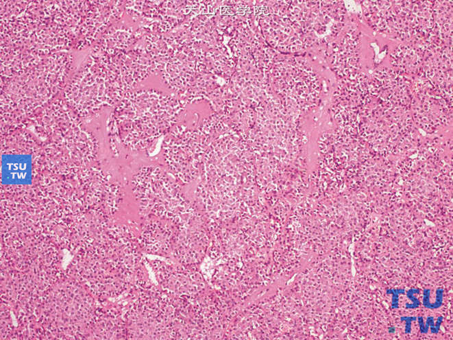 肾嗜酸细胞瘤（oncocytoma），示透明变性的间质