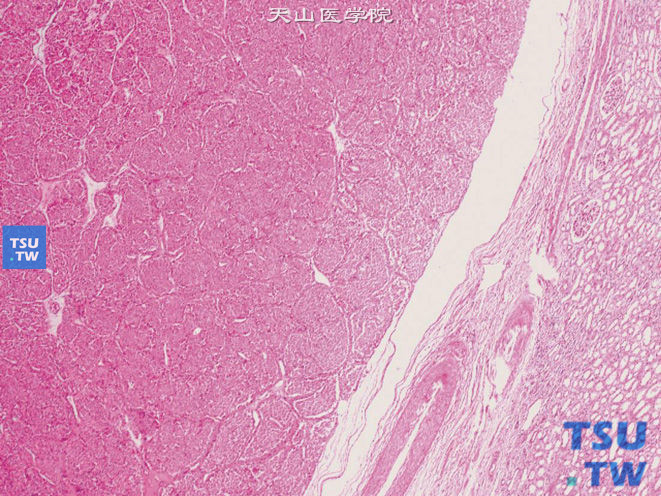 肾嗜酸细胞瘤（oncocytoma），肿瘤边界清楚，无包膜