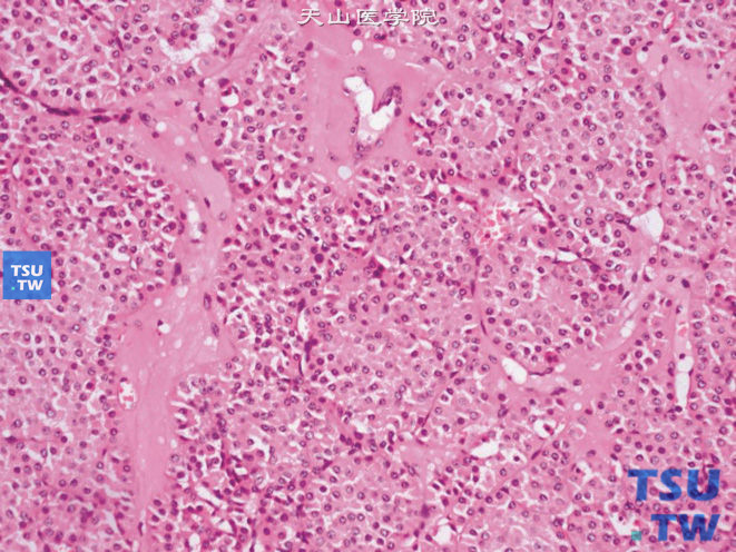 肾嗜酸细胞瘤（oncocytoma），示少数细胞胞质稀少，核质比升高，核染色深。间质透明变性