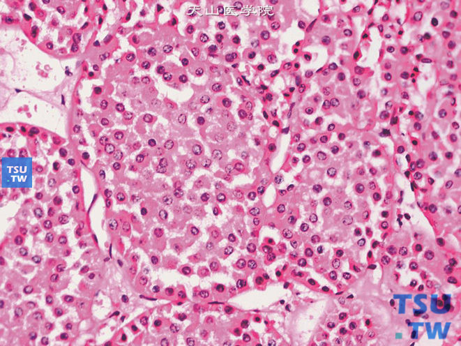 肾嗜酸细胞瘤（oncocytoma），核圆形、规则，染色质均匀分布，核仁小