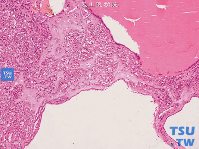 肾嗜酸细胞瘤，局部呈囊性结构
