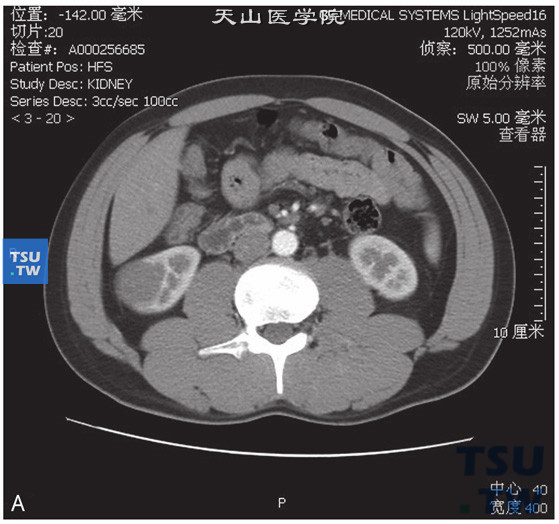 图A：后肾腺瘤。女，36岁，体检发现右肾占位。右肾下极略外凸，增强后可见右肾下极低强化占位，边缘清晰。增强后皮质期、实质期及分泌期，右肾占位均呈低强化
