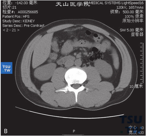图B：后肾腺瘤。女，36岁，体检发现右肾占位。右肾下极略外凸，增强后可见右肾下极低强化占位，边缘清晰。增强后皮质期、实质期及分泌期，右肾占位均呈低强化