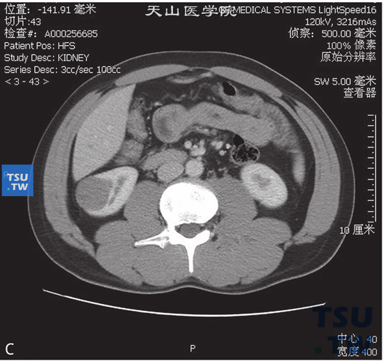 图C：后肾腺瘤。女，36岁，体检发现右肾占位。右肾下极略外凸，增强后可见右肾下极低强化占位，边缘清晰。增强后皮质期、实质期及分泌期，右肾占位均呈低强化