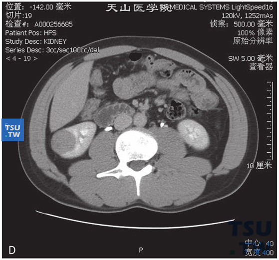 图D：后肾腺瘤。女，36岁，体检发现右肾占位。右肾下极略外凸，增强后可见右肾下极低强化占位，边缘清晰。增强后皮质期、实质期及分泌期，右肾占位均呈低强化