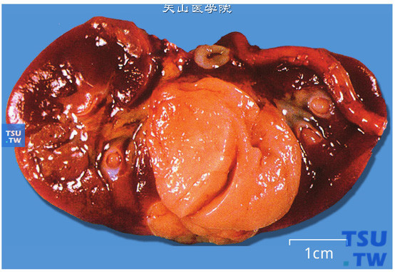 后肾腺瘤。肿瘤境界清楚，有时呈分叶状，切面灰黄色（大体）