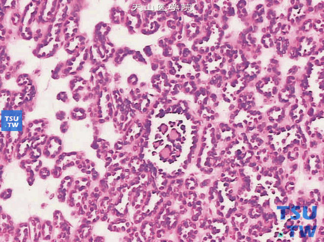 后肾腺瘤。示瘤组织形成腺管或小囊，其内腔有瘤细胞陷入并形成小乳头状，呈类似肾小球样结构