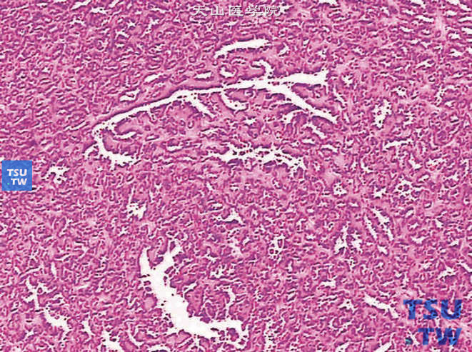 后肾腺瘤。示瘤组织可见长的分支状或鹿角状结构