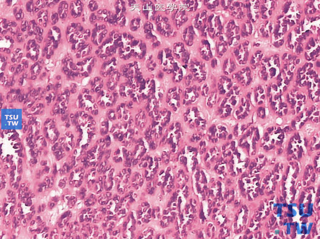后肾腺瘤。示瘤细胞有极少量嗜酸性胞质，胞核圆形或卵圆形，稍大于淋巴细胞。间质可发生透明变性