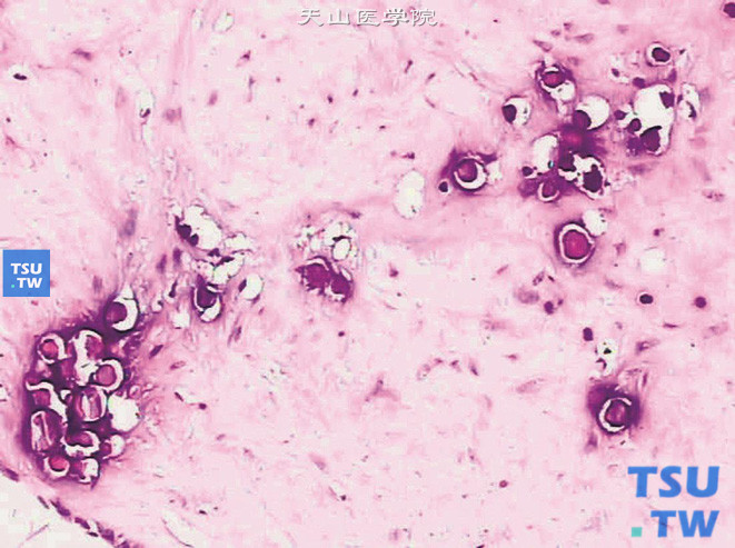 后肾腺瘤。示后肾腺瘤中的砂粒体