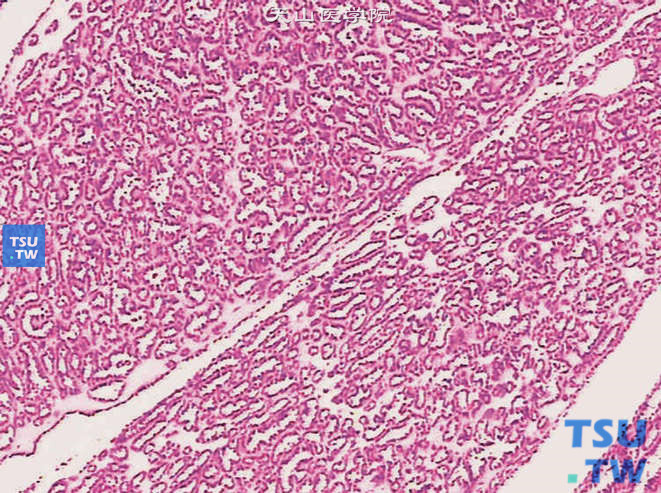 后肾腺瘤。示瘤组织中的腺管状结构
