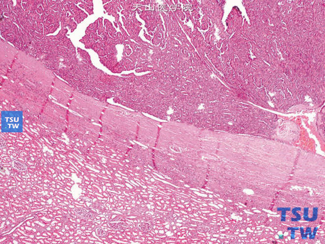后肾腺瘤，示肿瘤与肾脏分界清楚