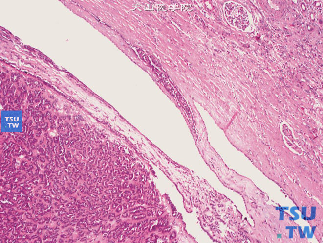 后肾腺瘤，示肿瘤与肾脏分界清楚