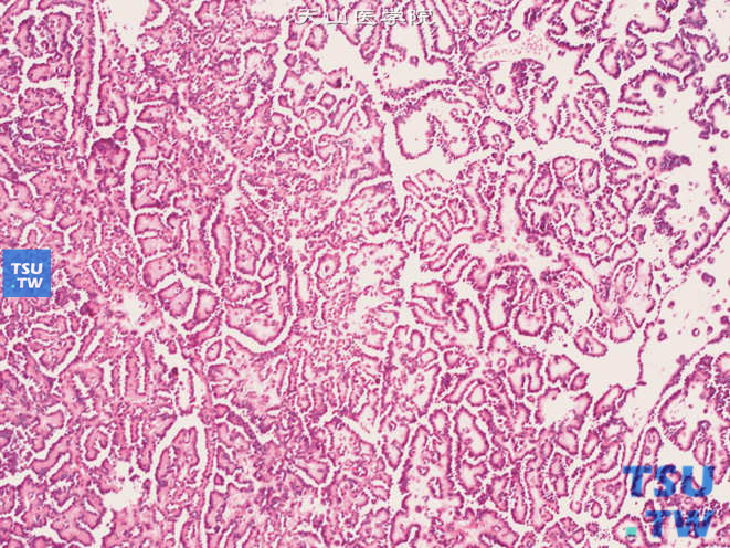 后肾腺瘤，示鹿角状及长的分枝状小管结构