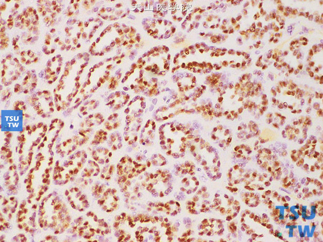 后肾腺瘤，示WT1染色核+，高倍