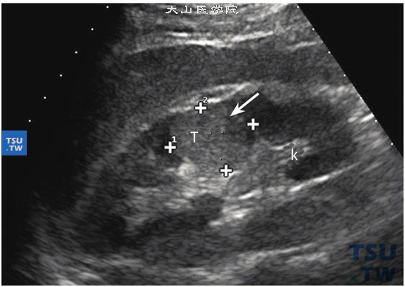 透明细胞型肾细胞癌低回声超声图像特点：成人肾癌多发生于一侧肾脏，常为单个肿瘤，多发双侧较少见。在病理上可分成若干种类型，但在超声中很难做出病理样分型，但肾癌在超声诊断中有它的共同特点，肾内出现异常回声团块，多数表现为低回声、中等回声实性结节，极少数为偏高回声肿物。超声可以根据肿瘤大小及侵及周围组织的程度进行临床分期，为临床治疗及病人预后提供参考。该病例肾中部可见3.13cm×2.43cm大小低回声肿物，不向肾外凸出，外形规则，内部回声不均匀，肾静脉及下腔静脉未见瘤栓，肾门旁及腹膜后未见肿大淋巴结。此病例声像图特点，低回声肿物，体积小，病变局限，肿物边界清晰。提示肾癌T1N0V0Mx（T：肿瘤）