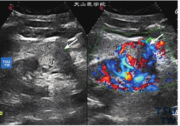 透明细胞型肾细胞癌中等回声超声图像特点：肾中下极中等回声实性肿物，明显向肾外凸出，外形规则，内部回声欠均匀，右图提示血流非常丰富，血管包绕肿物。此病例声像图特点，中等回声肿物，体积小，病变局限，肿物边界清晰。提示肾癌T1N0V0Mx