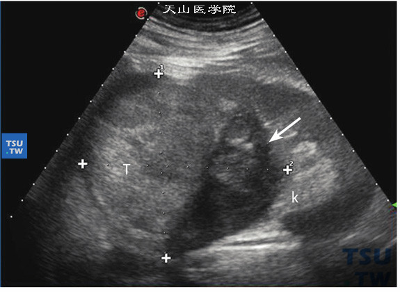 肾癌超声图片