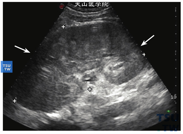 透明细胞型肾细胞癌肾内弥漫性低回声无明显结节超声图像特点：大多肾癌超声图像在肾内可明确探查到结节样肿物，该病例属不常见类型图像，肾的正常形态消失，体积增大16.33cm×7.87cm，肾内弥漫性不均质低回声改变，正常肾窦内偏强回声消失，肾被膜仍然完整光滑，无明显向肾外凸出结节