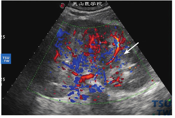 透明细胞型肾细胞癌肾内血管异常超声图像特点：肾内血流信号极为丰富。血管走行杂乱，完全失去血管正常呈“树枝”状分布形态