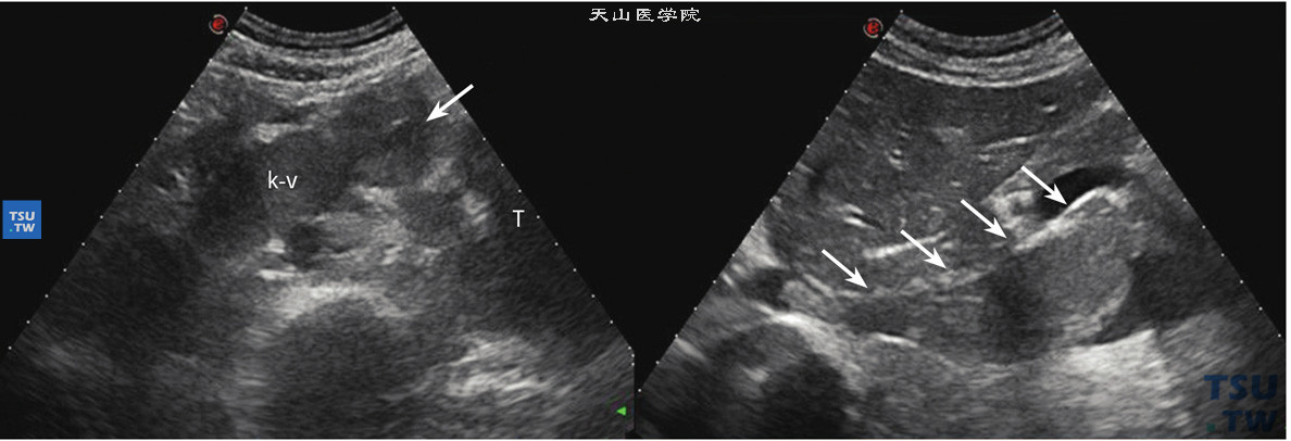 透明细胞型肾细胞癌合并肾静脉及下腔静脉瘤栓超声图像特点：患侧肾静脉扩张，腔内可见低回声肿物延续至下腔静脉。左图箭头指示肾静脉瘤栓，右图指示为下腔静脉瘤栓。病理结果：肾细胞癌透明细胞型G2，浸润肾周脂肪，伴大片坏死，肾静脉下腔静脉瘤栓为癌组织