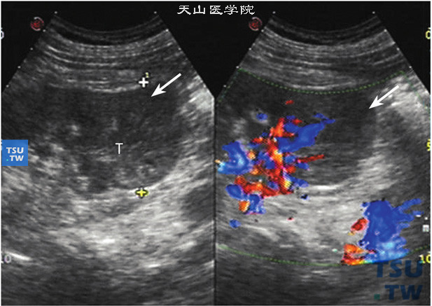 透明细胞型肾细胞癌肿物体积小于5.0cm但已合并肾静脉及下腔静脉瘤栓超声图像特点：患肾下极类圆形直径4.91cm低回声实性肿物（箭头指示），结节局限，体积不大，但肾静脉内及下腔静脉内均可见瘤栓。临床分期：肾癌T3期