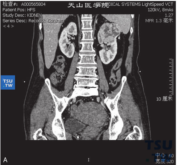 图A：CT，透明细胞癌。男，59岁，血尿。左肾上极见一不均匀软组织密度灶，部分凸出肾轮廓外，内部呈低密度，增强后肿物明显强化，内部见无强化坏死区，延迟期呈低密度