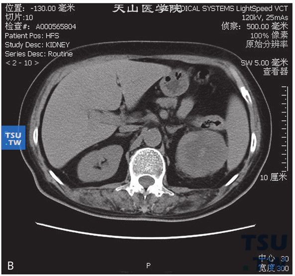 图B：CT，透明细胞癌。男，59岁，血尿。左肾上极见一不均匀软组织密度灶，部分凸出肾轮廓外，内部呈低密度，增强后肿物明显强化，内部见无强化坏死区，延迟期呈低密度