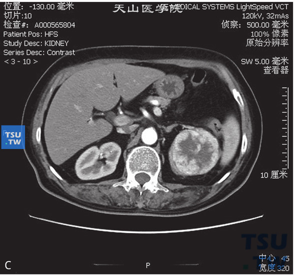 图C：CT，透明细胞癌。男，59岁，血尿。左肾上极见一不均匀软组织密度灶，部分凸出肾轮廓外，内部呈低密度，增强后肿物明显强化，内部见无强化坏死区，延迟期呈低密度
