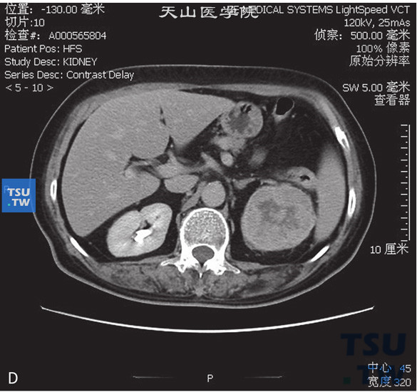 图D：CT，透明细胞癌。男，59岁，血尿。左肾上极见一不均匀软组织密度灶，部分凸出肾轮廓外，内部呈低密度，增强后肿物明显强化，内部见无强化坏死区，延迟期呈低密度