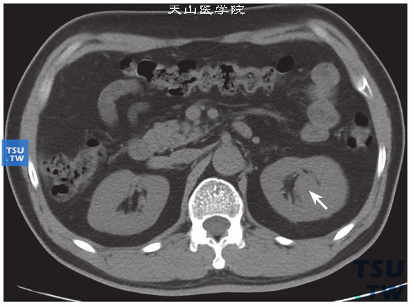 CT与MR对比，左肾透明细胞癌，易误诊为肥大肾柱。CT平扫病变不明显，病变似肥大肾柱