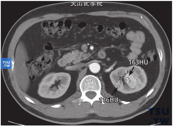 CT与MR对比，左肾透明细胞癌，易误诊为肥大肾柱。CT皮髓质期病变明显强化（163HU），高于皮质强化（116HU）