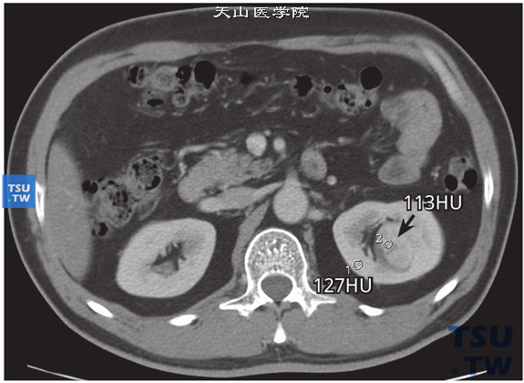 CT与MR对比，左肾透明细胞癌，易误诊为肥大肾柱。CT实质期病变与皮质CT参考值分别为113HU、127HU