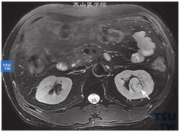 CT与MR对比，左肾透明细胞癌，易误诊为肥大肾柱。T2WI病变呈等信号，似肥大肾柱