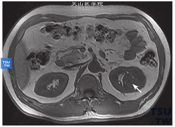 CT与MR对比，左肾透明细胞癌，易误诊为肥大肾柱。T1WI病变呈等信号，似肥大肾柱
