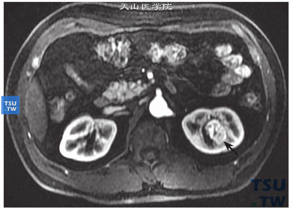 CT与MR对比，左肾透明细胞癌，易误诊为肥大肾柱。MR增强动脉期病变强化略高于肾皮质