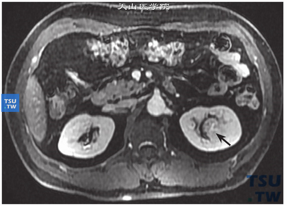 CT与MR对比，左肾透明细胞癌，易误诊为肥大肾柱。MR增强实质期病变强化略低于肾皮质