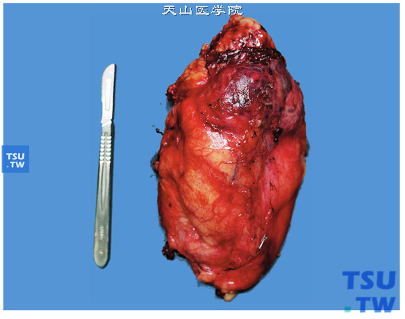 透明细胞型肾细胞癌（大体）。肿瘤体积较大，侵犯肾周脂肪