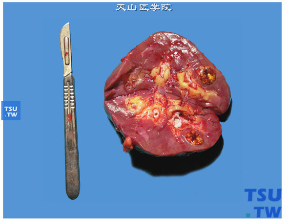 透明细胞型肾细胞癌（切面）。肿瘤切面杂色，境界清楚，可见假包膜