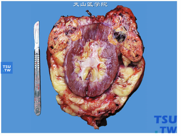 透明细胞型肾细胞癌（切面）。肿瘤形状不规则，突向肾外生长，并侵犯肾周围脂肪