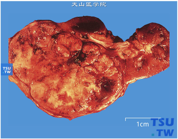 透明细胞型肾细胞癌。肿瘤有假包膜，中心有出血、坏死及纤维条索样间隔（切面）