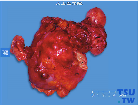 有肉瘤样分化的肾细胞癌（大体）