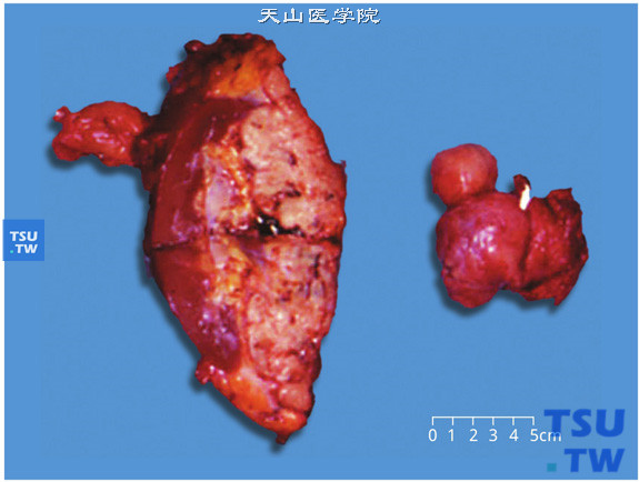 有肉瘤样分化的肾细胞癌（大体）。切面有黄褐色区和灰白色区