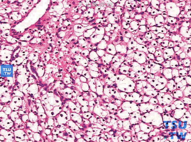 透明细胞癌G1，癌细胞排列成腺样或泡巢状结构。癌巢间的间质为薄壁毛细血管，纤维细胞很少