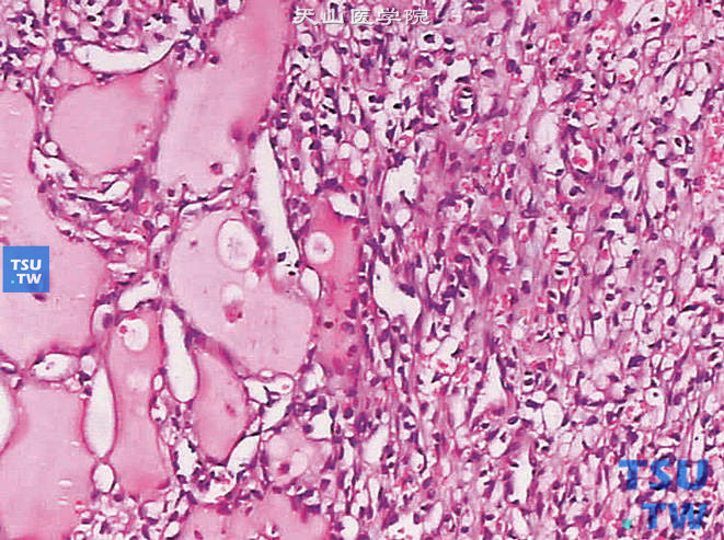 肾透明细胞型肾细胞癌，腺腔扩张呈多囊性结构